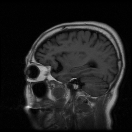 File:Atypical meningioma with skull invasion (Radiopaedia 34357-35648 Sagittal T1 7).png