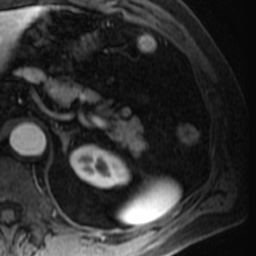 File:Atypical renal cyst on MRI (Radiopaedia 17349-17046 C 5).jpg