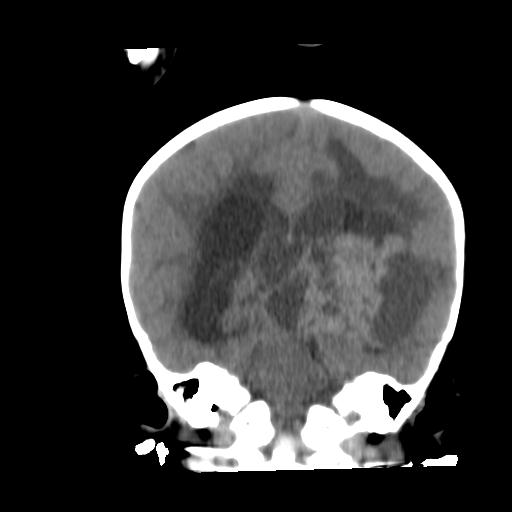 Atypical teratoid rhabdoid tumor (AT-RT) (Radiopaedia 85823-101654 Coronal non-contrast 32).jpg