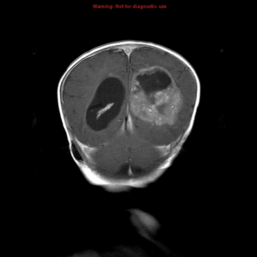 File:Atypical teratoid rhabdoid tumor (Radiopaedia 10712-11183 Coronal T1 C+ 5).jpg