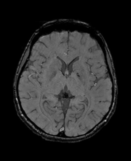 Autoimmune limbic encephalitis (Radiopaedia 30363-31005 SWI - magnitude 40).jpg