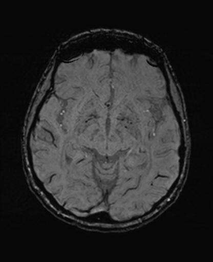 Autoimmune limbic encephalitis (Radiopaedia 30363-31005 SWI 35).jpg