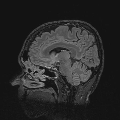 Autoimmune limbic encephalitis (Radiopaedia 30363-31005 Sagittal FLAIR 88).jpg