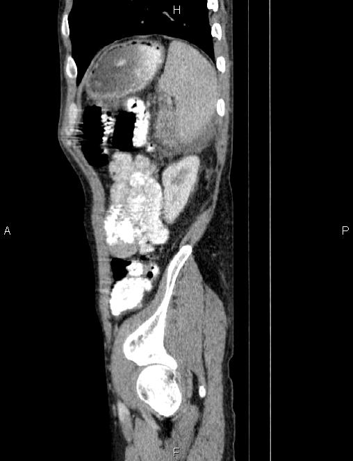 Autoimmune pancreatitis (Radiopaedia 84925-100431 E 81).jpg