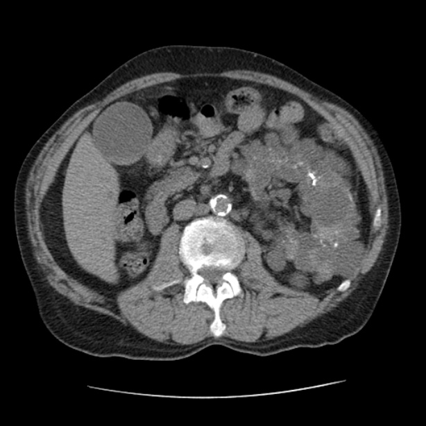 Autosomal dominant polycystic kidney disease (Radiopaedia 27851-28094 Axial non-contrast 71).jpg