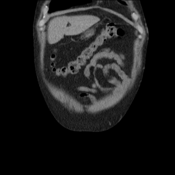 Autosomal dominant polycystic kidney disease (Radiopaedia 36539-38101 C 11).jpg