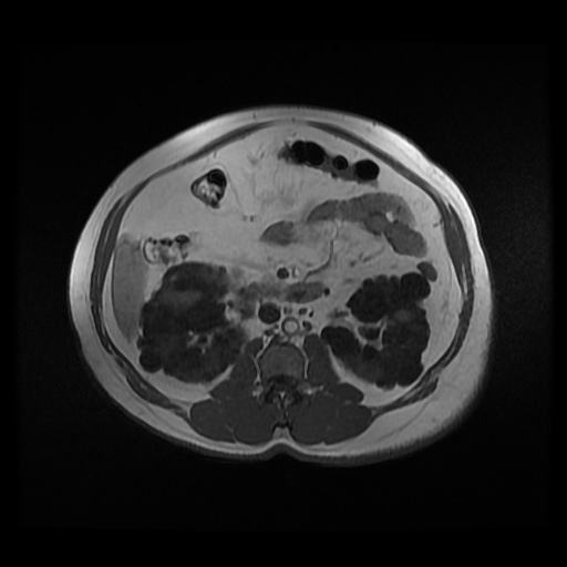 Autosomal dominant polycystic kidney disease (Radiopaedia 50259-55611 Axial 2D Dual Echo 48).jpg