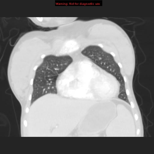File:Avascular necrosis in sickle cell disease (Radiopaedia 17448-17152 B 34).jpg