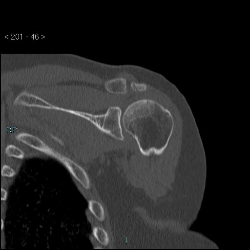 Avascular necrosis of the shoulder - Cruess stage I (Radiopaedia 77674-89887 Coronal bone window 45).jpg