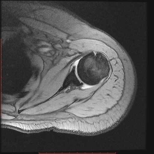 File:Avulsion fracture - greater tuberosity of humerus (Radiopaedia 25457-25703 Axial Gradient Echo 10).jpg