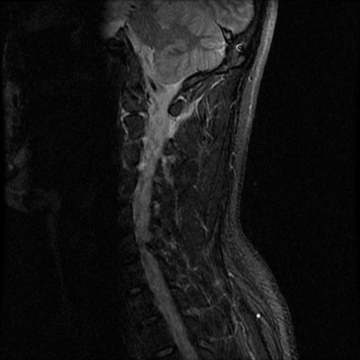File:Axis fracture - MRI (Radiopaedia 71925-82375 Sagittal STIR 3).jpg