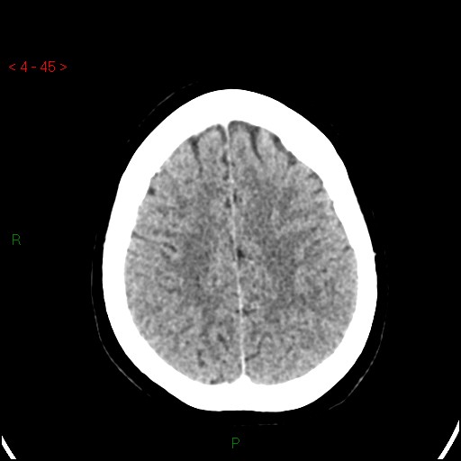 Azygos anterior cerebral artery (Radiopaedia 51987-57833 A 45).jpg