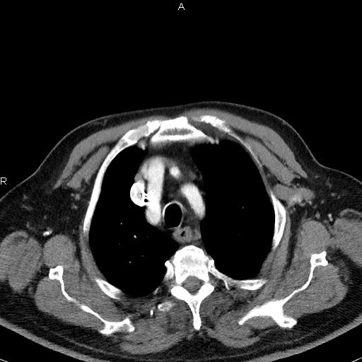 Azygos continuation of the inferior vena cava (Radiopaedia 18537-18404 C+ arterial phase 13).jpg