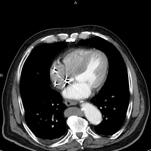Azygos continuation of the inferior vena cava (Radiopaedia 18537-18404 C+ arterial phase 38).jpg