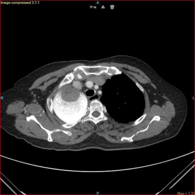 Azygos vein aneurysm (Radiopaedia 77824-90130 B 14).jpg