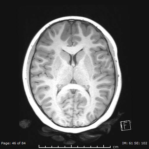 Balo concentric sclerosis (Radiopaedia 61637-69636 Axial T1 46).jpg