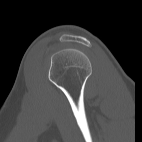 Bankart lesion (Radiopaedia 57256-64185 Sagittal bone window 19).jpg