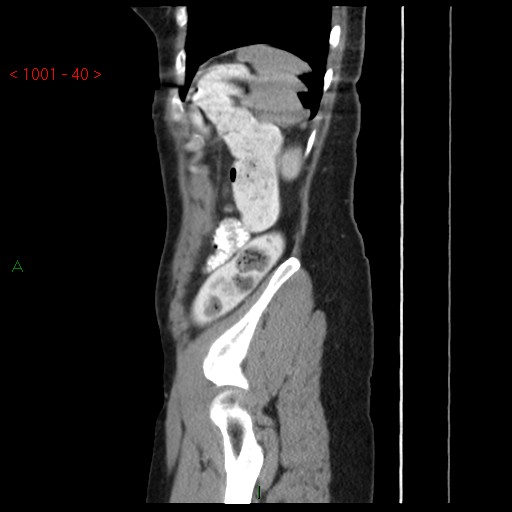 File:Bartholin gland cyst (Radiopaedia 54904-61181 Sagittal C+ delayed 40).jpg