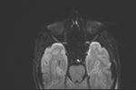 File:Basal cell carcinoma - nasal region (Radiopaedia 70292-80365 Axial DWI 21).jpg