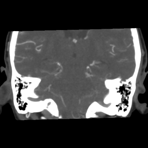 File:Basilar artery fenestration and aneurysms with subarachnoid hemorrhage (Radiopaedia 40066-42573 B 33).png