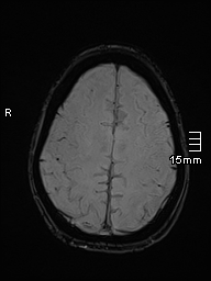 Basilar artery perforator aneurysm (Radiopaedia 82455-99523 Axial SWI 53).jpg