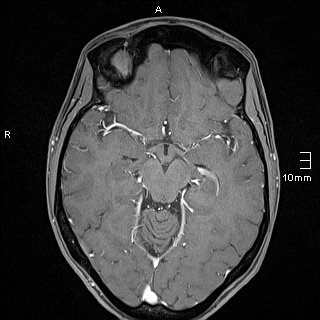 File:Basilar artery perforator aneurysm (Radiopaedia 82455-99523 G 61).jpg