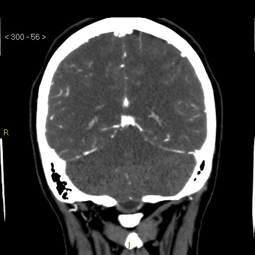File:Basilar artery thrombosis (Radiopaedia 16260-15944 B 47).jpg