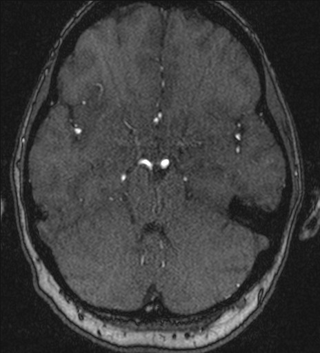 Basilar tip aneurysm (Radiopaedia 26504-26632 MRA 81).jpg