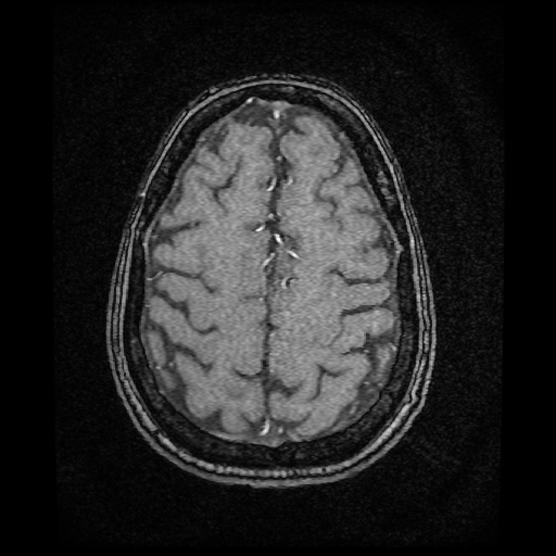 Basilar top and left middle cerebral artery aneurysm (Radiopaedia 61965-70031 Axial MRA 138).jpg