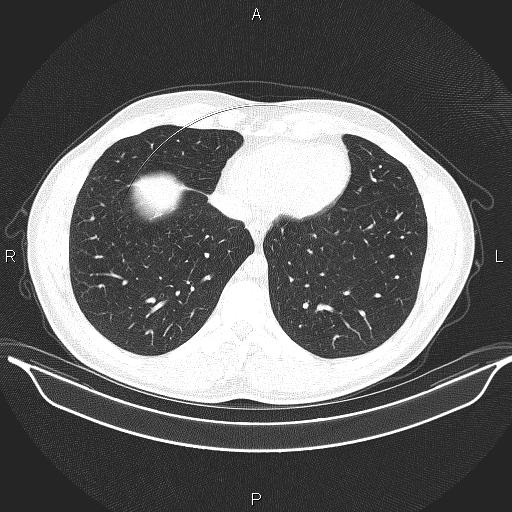 Beam hardening and ring artifacts (Radiopaedia 85323-100915 Axial lung window 58).jpg