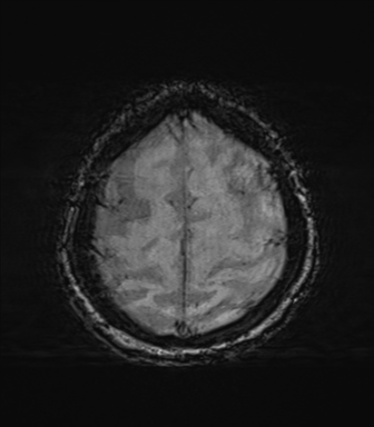 File:Behavioral variant frontotemporal dementia and late onset schizophrenia (Radiopaedia 52197-58083 Axial SWI 66).png