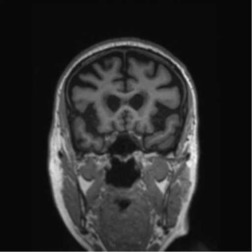 Behavioral variant frontotemporal dementia and late onset schizophrenia (Radiopaedia 52197-58083 Coronal T1 63).png