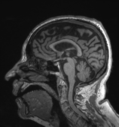 Behavioral variant frontotemporal dementia and late onset schizophrenia (Radiopaedia 52197-58083 Sagittal T1 51).png