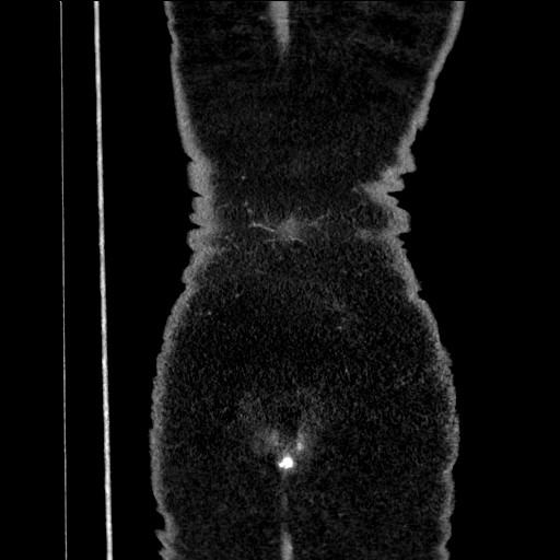 Benign leiomyoma with hydropic features (Radiopaedia 89250-106130 B 108).jpg