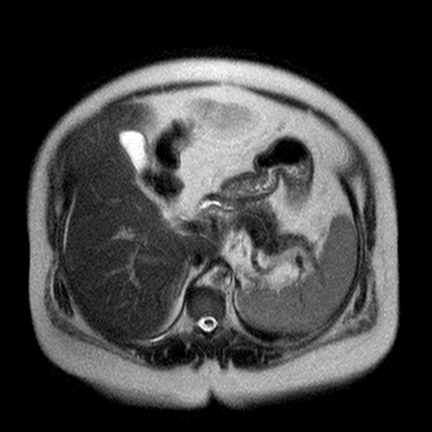 File:Benign seromucinous cystadenoma of the ovary (Radiopaedia 71065-81300 Axial T2 15).jpg