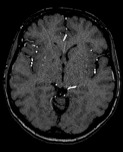 Berry aneurysm of the terminal internal carotid artery (Radiopaedia 88286-104918 Axial TOF 121).jpg