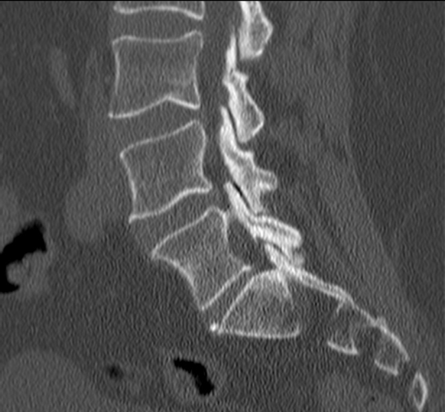 Bertolotti syndrome (Radiopaedia 24864-25128 Sagittal bone window 23).jpg