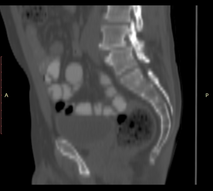 Bertolotti syndrome (Radiopaedia 58974-66235 Sagittal bone window 20).jpg
