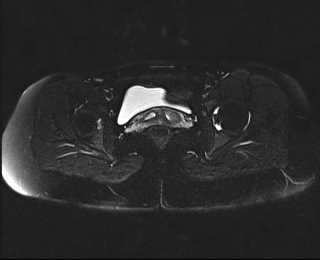 File:Bicornuate bicollis uterus (Radiopaedia 61626-69616 Axial PD fat sat 25).jpg