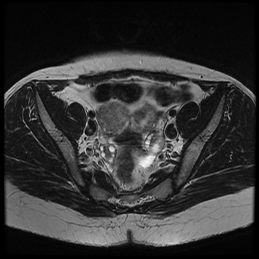File:Bicornuate uterus (Radiopaedia 51676-57472 Axial T2 22).jpg
