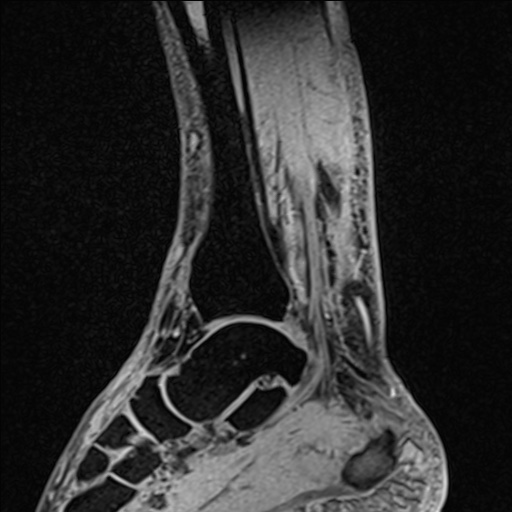 Bilateral Achilles tendon complete tear (Radiopaedia 81344-95051 Sagittal WE - Right 69).jpg