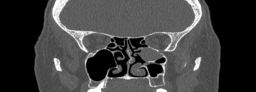 Bilateral Ectopic Infraorbital Nerves (Radiopaedia 49006-54084 Coronal bone window 46).jpg