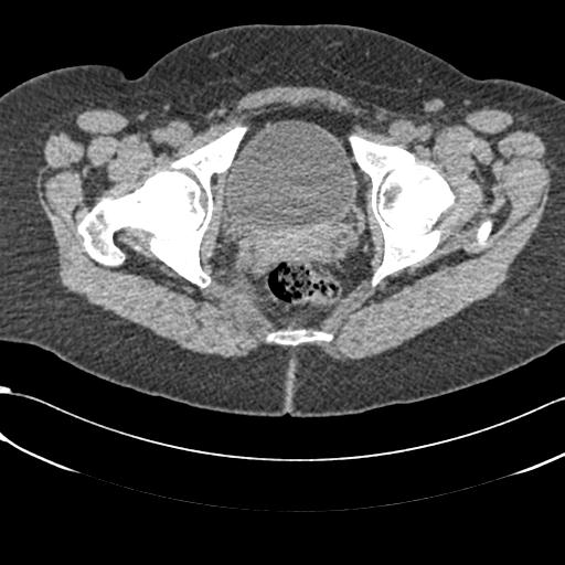 File:Bilateral acetabular protrusion with pincer type femoro-acetabular impingement (Radiopaedia 30134-30733 AXIAL SOFT THIN 49).jpg