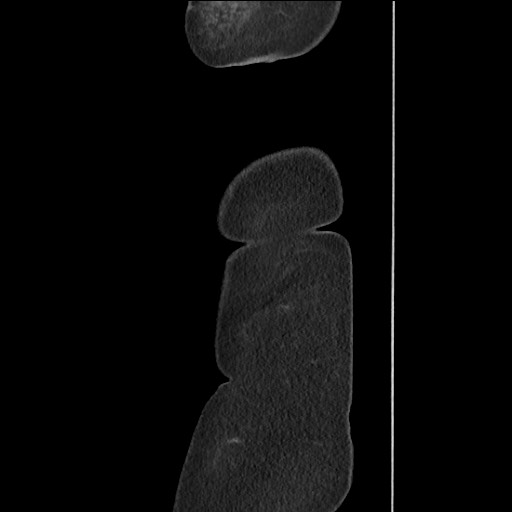 Bilateral adrenal granulocytic sarcomas (chloromas) (Radiopaedia 78375-91007 C 134).jpg