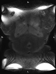Bilateral adrenal myelolipoma (Radiopaedia 63058-71537 Coronal T1 fat sat 104).jpg