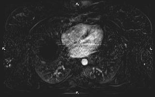 Bilateral adrenal myelolipoma (Radiopaedia 63058-71537 I 4).jpg