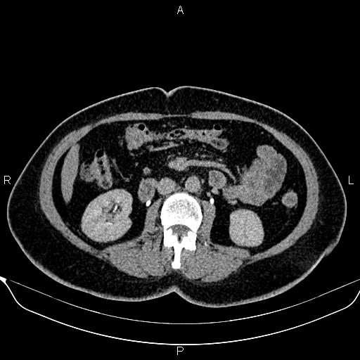 File:Bilateral benign adrenal adenomas (Radiopaedia 86912-103124 Axial C+ delayed 72).jpg