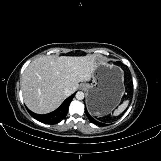Bilateral benign adrenal adenomas (Radiopaedia 86912-103124 B 21).jpg
