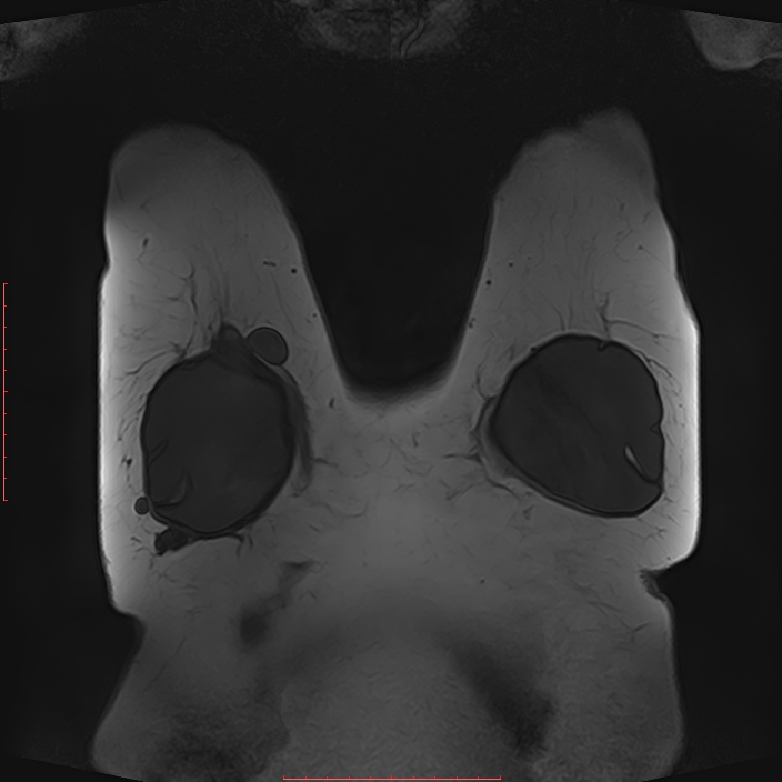 Bilateral breast implant rupture (Radiopaedia 24761-25027 G 58).jpg