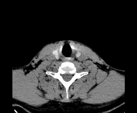 Bilateral carotid body tumors (Radiopaedia 61841-69870 Axial non-contrast 84).jpg